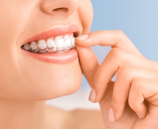 Closeup of dental patient placing an Invisalign tray