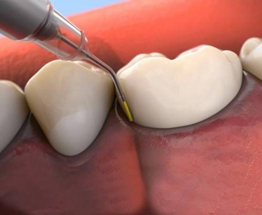Animated smile during periodontal disease treatment