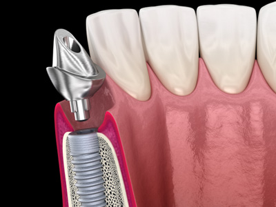 A 3D illustration of a dental implant abutment