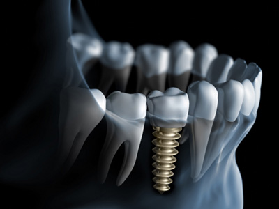 : A 3D illustration of a completed dental implant