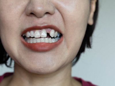 A closeup of a woman with a missing tooth