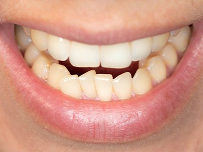 A closeup of a mouth with crowded teeth