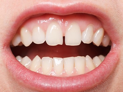 A closeup of a gap between the upper incisors