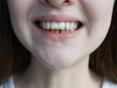 A woman with an overbite