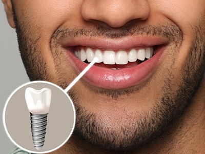 A photo highlighting a man’s completed dental implant