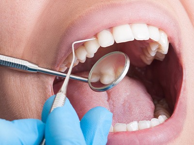 A closeup of a mouth receiving a dental checkup
