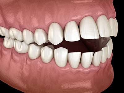A 3D illustration of a mouth with an open bite