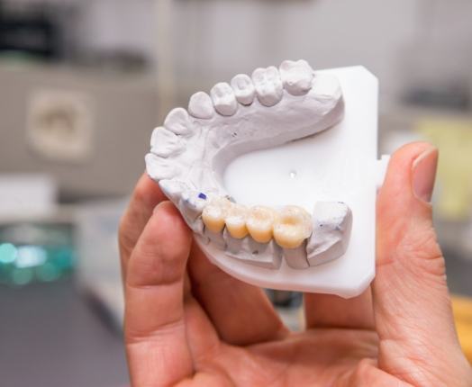 Model smile with a dental bridge restoration in place
