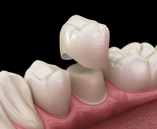 Animated smile during dental crown placement