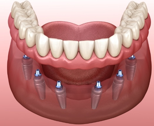 Animated smile during dental implant treatment as part of full mouth reconstruction