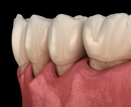 Animated smile with warning signs of a need for gum disease treatment