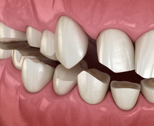 Animated smile with worn down teeth due to bruxism