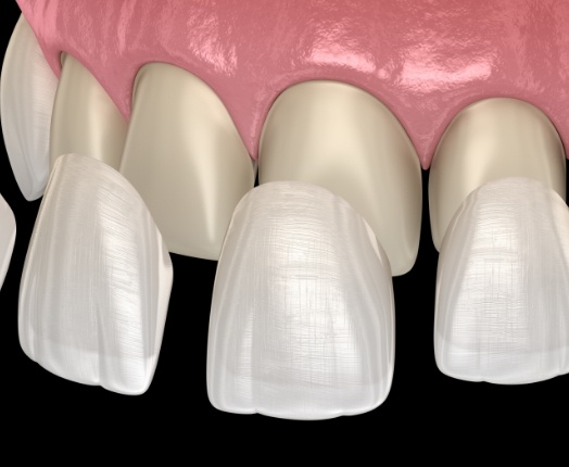 Animated smile during veneers placement