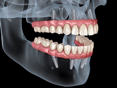 A 3D illustration of all-on-4 dentures
