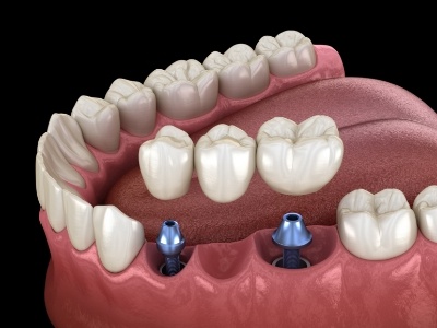 Animated smile during dental implant supported fixed bridge placement