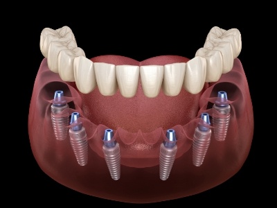 two dental implants with a bridge