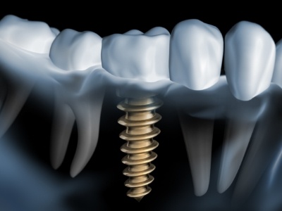 implant dentist in Temple showing a patient a model of a dental implant