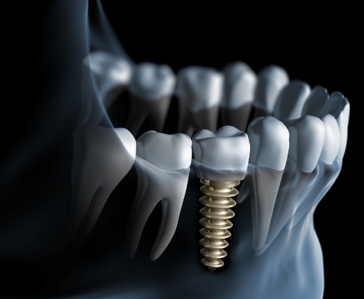 Animated smile during dental implant supported dental crown placement