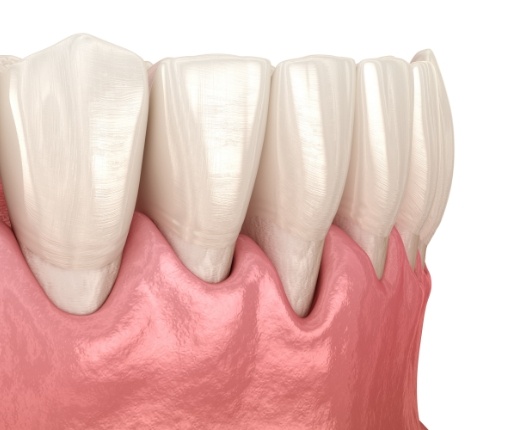 Animated smile with receding gums before oral surgery