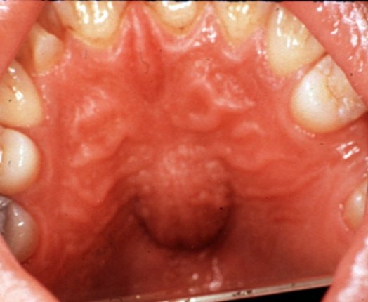 Smile with palatal cyst