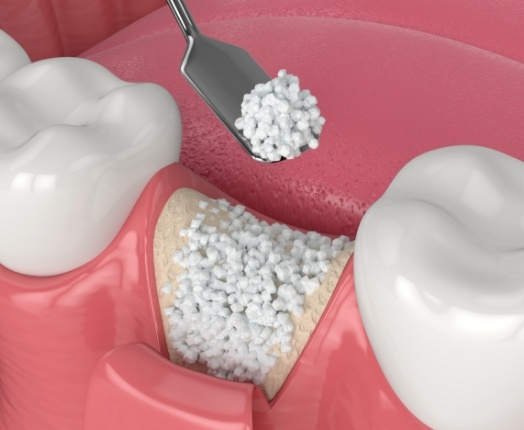 Animated smile during bone grafting treatment