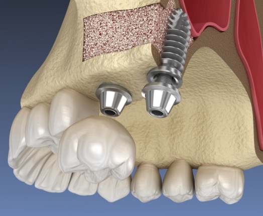 Animated smile with dental implant placement after sinus lift treatment