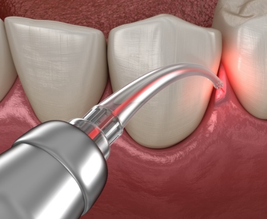 Closeup of smile during periodontal disease treatment