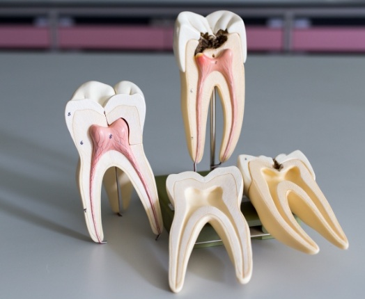 Two model teeth used to compare a healthy tooth to one that needs a root canal