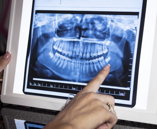 Digital x-rays on chairside computer monitor