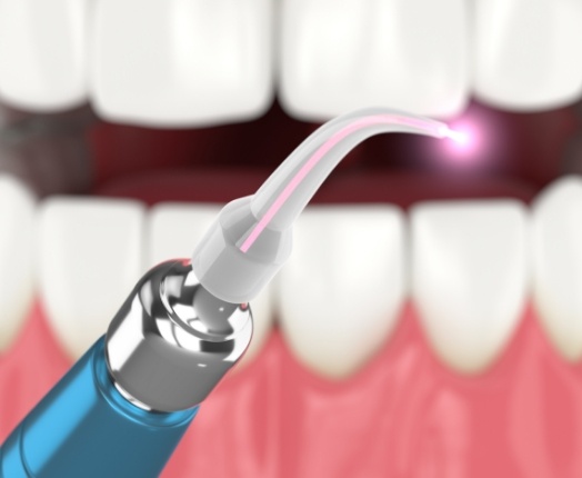 Closeup of animated smile during laser dentistry treatment