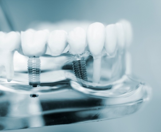 3 D dental implant model