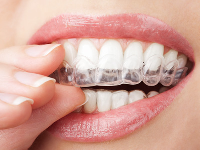 A closeup of a mouth placing a teeth whitening tray