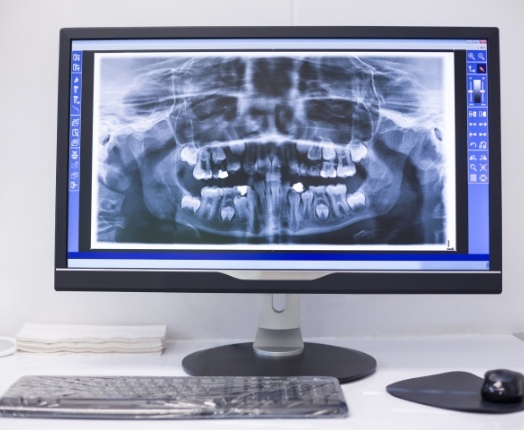 Digital x-rays on chairside computer