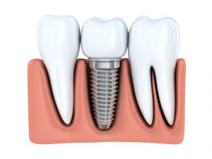 Are you a candidate for dental implants in Temple?