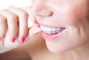 Why should I get Invisalign in Temple?