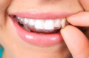 5 essential questions about Invisalign in Temple.