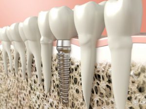 An Illustration of dental implants.
