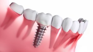 Model of a dental implant in the lower jaw