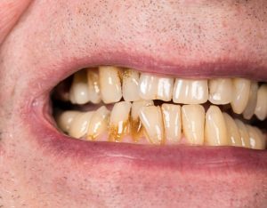 man with yellow teeth gum disease