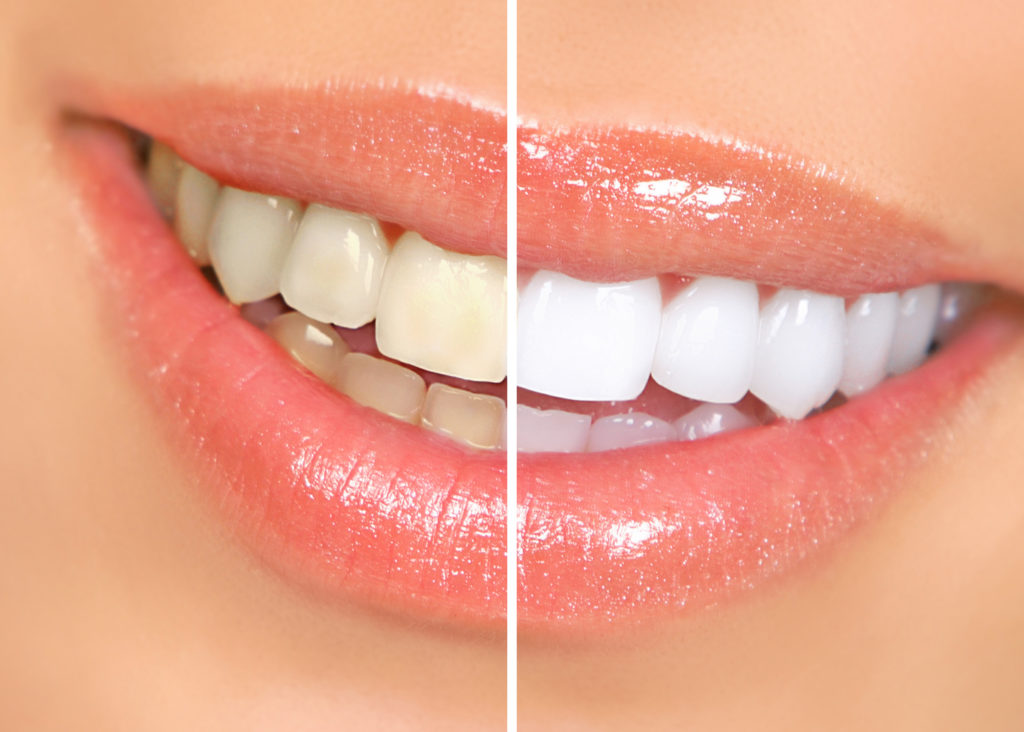 Woman smiling with teeth whitening in Temple