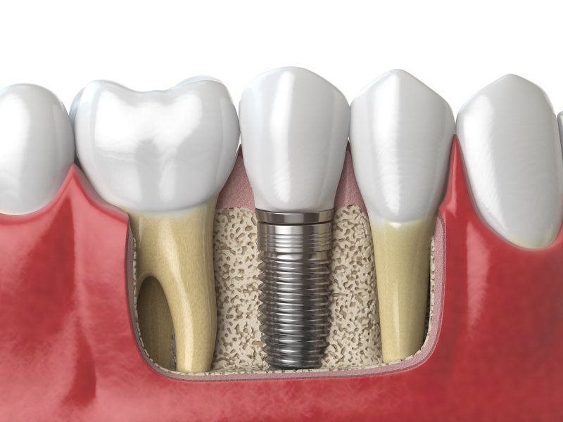 Illustration of dental implants in Temple