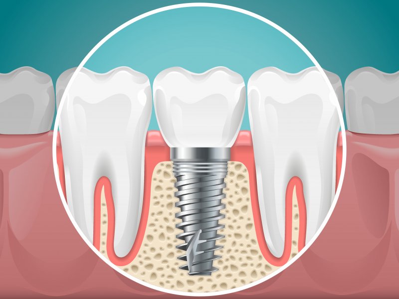 Graphic of dental implant
