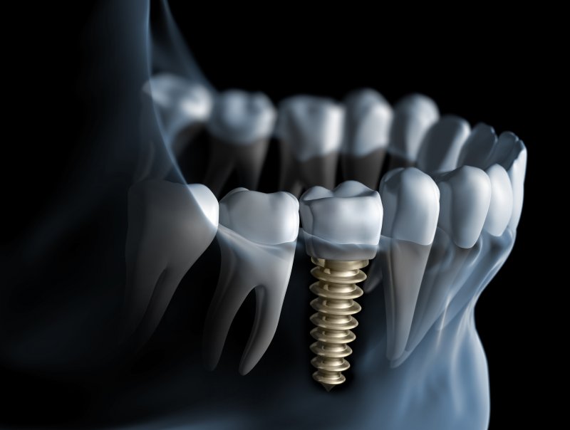 Dental implant