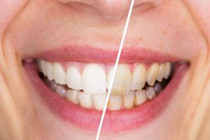 teeth whitening from dentist in Temple