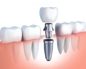 dental implants illustration