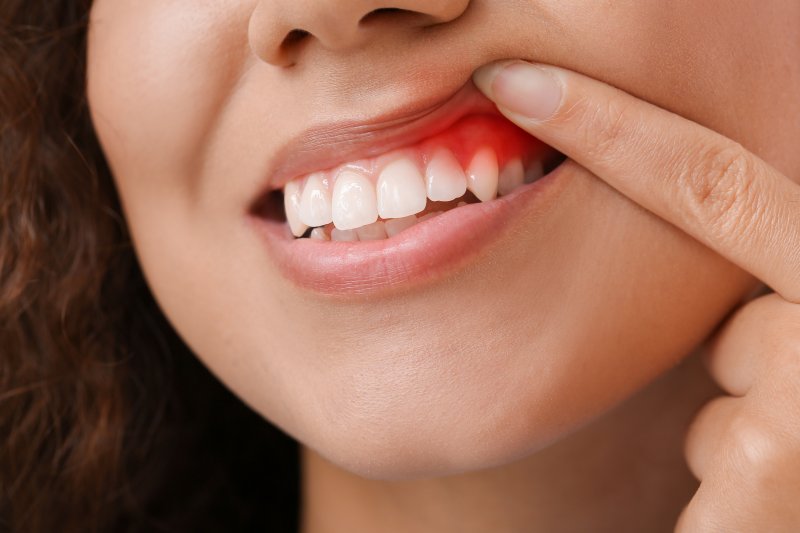 A closeup of a woman with gum inflammation